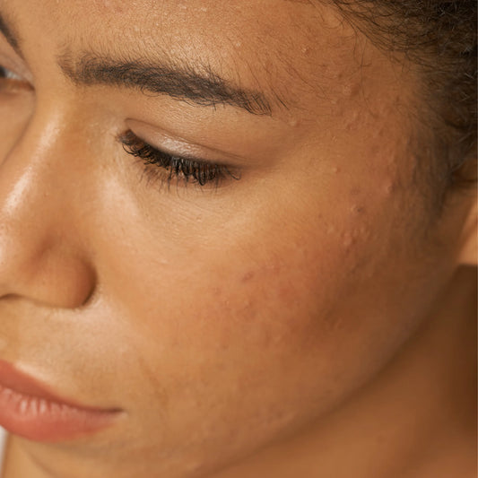 Your Skin Is Breaking Out After Using Exosome 2000. That Means It Is Working.